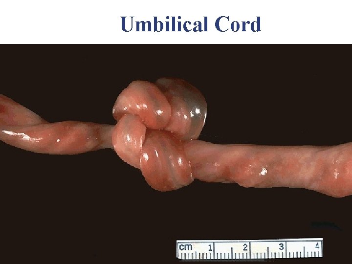 Umbilical Cord Umbilical Cord