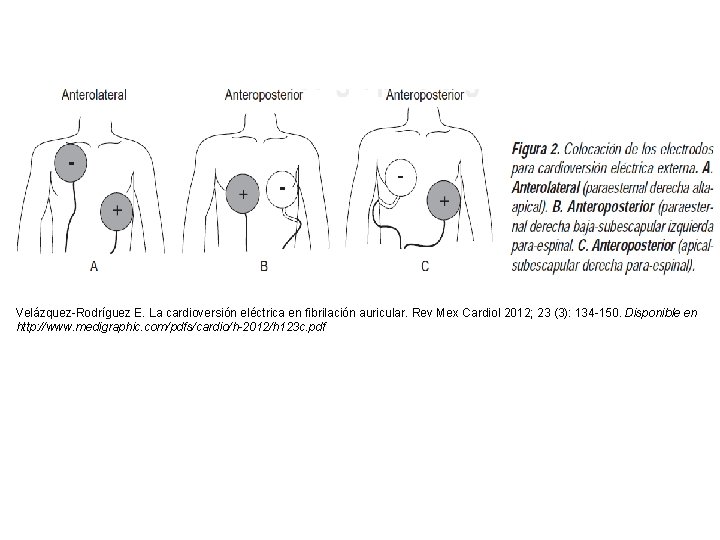 Velázquez-Rodríguez E. La cardioversión eléctrica en fibrilación auricular. Rev Mex Cardiol 2012; 23 (3):