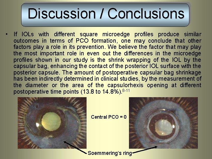 Discussion / Conclusions • If IOLs with different square microedge profiles produce similar outcomes Discussion / Conclusions • If IOLs with different square microedge profiles produce similar outcomes