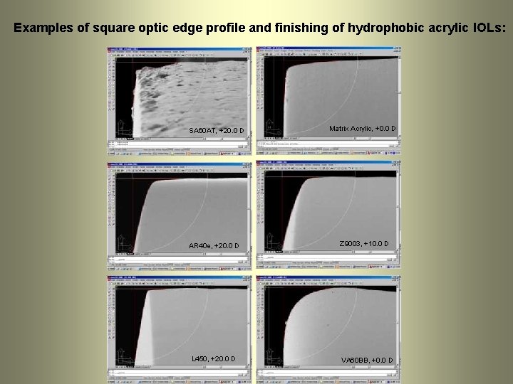 Examples of square optic edge profile and finishing of hydrophobic acrylic IOLs: SA 60 Examples of square optic edge profile and finishing of hydrophobic acrylic IOLs: SA 60