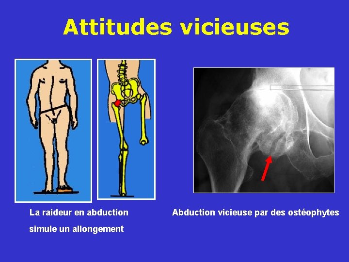 Attitudes vicieuses La raideur en abduction simule un allongement Abduction vicieuse par des ostéophytes