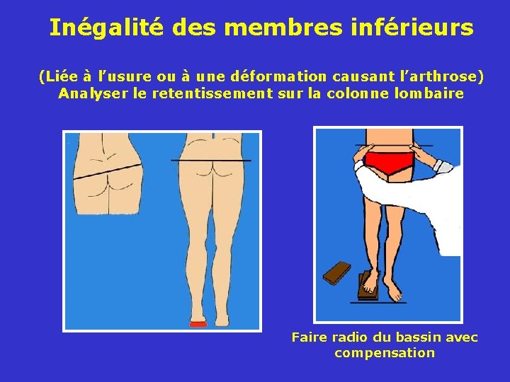 Inégalité des membres inférieurs (Liée à l’usure ou à une déformation causant l’arthrose) Analyser