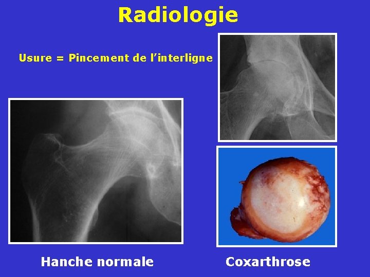 Radiologie Usure = Pincement de l’interligne Hanche normale Coxarthrose 