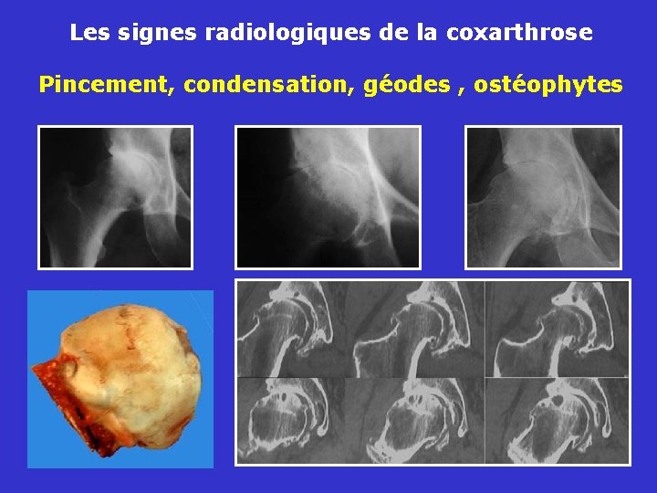 Les signes radiologiques de la coxarthrose Pincement, condensation, géodes , ostéophytes 