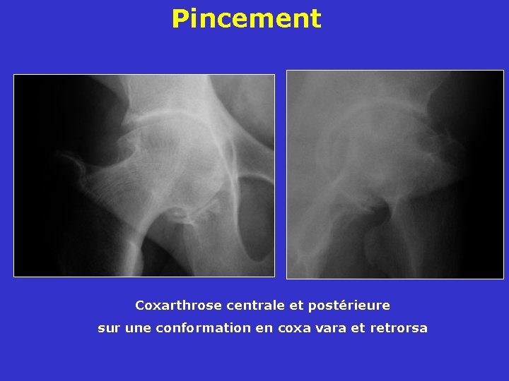Pincement Coxarthrose centrale et postérieure sur une conformation en coxa vara et retrorsa 