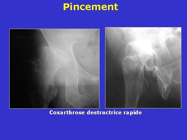 Pincement Coxarthrose destructrice rapide 