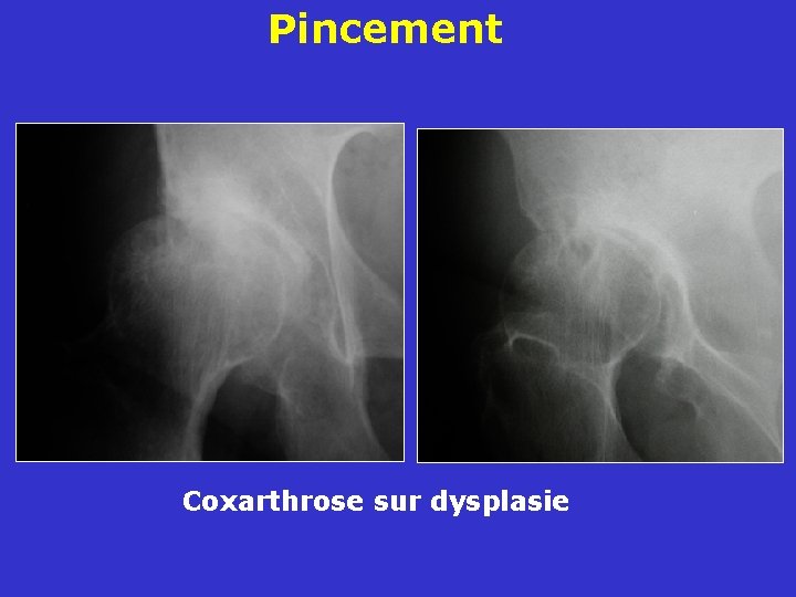 Pincement Coxarthrose sur dysplasie 