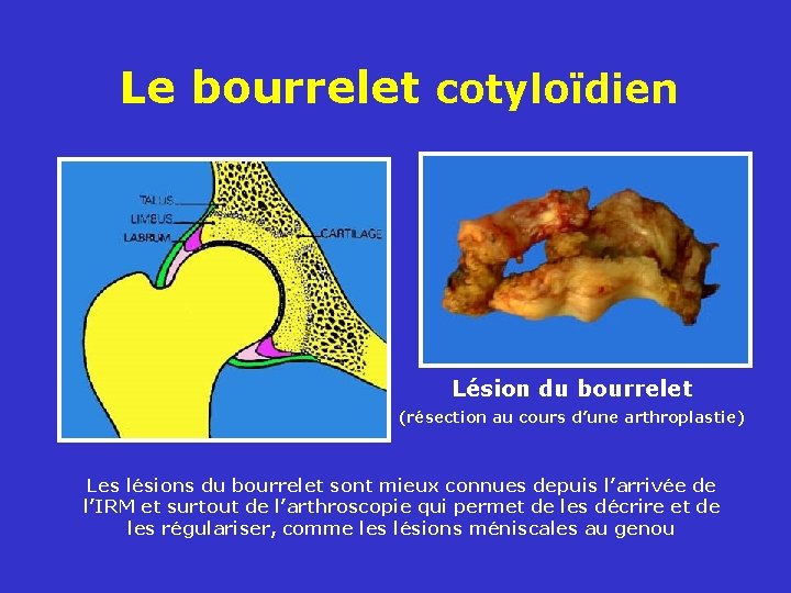 Le bourrelet cotyloïdien Lésion du bourrelet (résection au cours d’une arthroplastie) Les lésions du