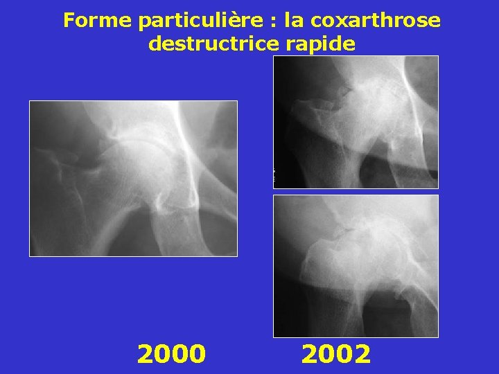 Forme particulière : la coxarthrose destructrice rapide 2000 2002 