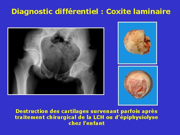 Diagnostic différentiel : Coxite laminaire Destruction des cartilages survenant parfois après traitement chirurgical de