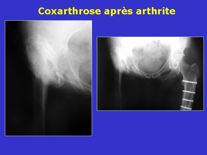 Coxarthrose après arthrite 