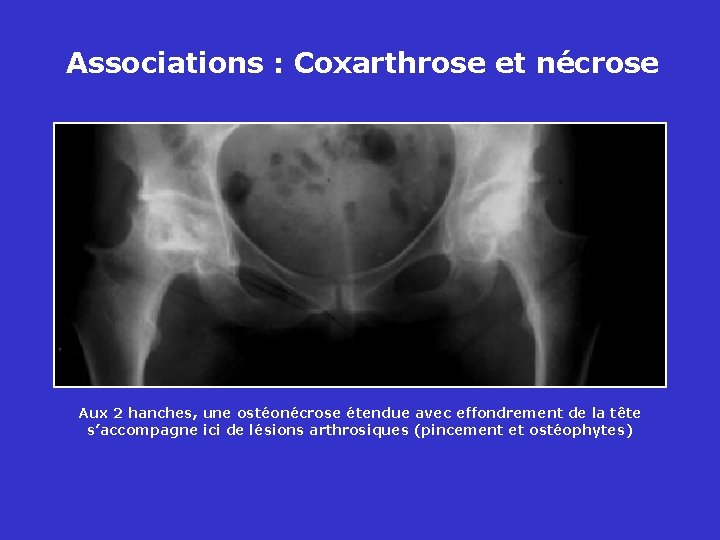 Associations : Coxarthrose et nécrose Aux 2 hanches, une ostéonécrose étendue avec effondrement de