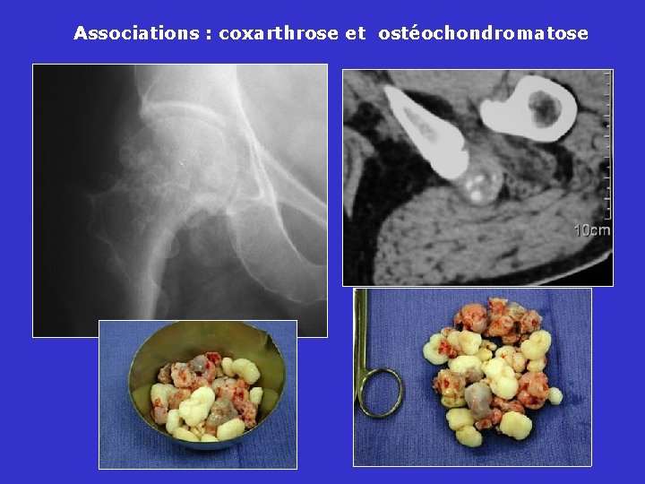 Associations : coxarthrose et ostéochondromatose 