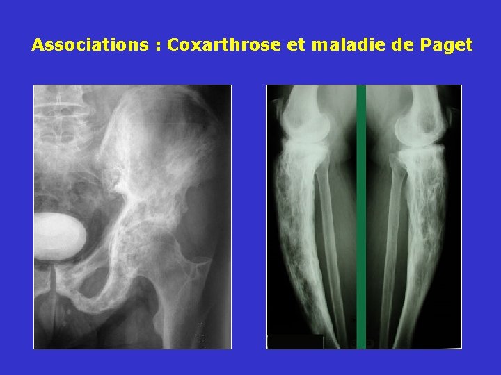 Associations : Coxarthrose et maladie de Paget 