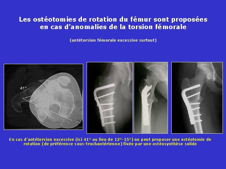 Les ostéotomies de rotation du fémur sont proposées en cas d’anomalies de la torsion