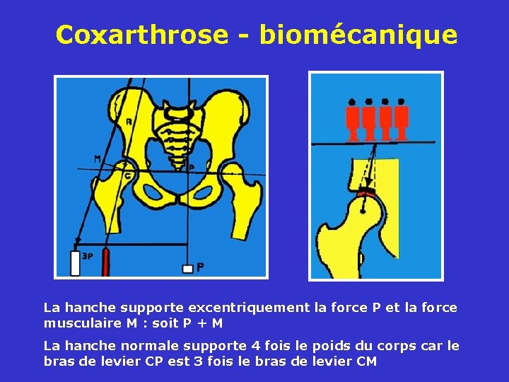 Coxarthrose - biomécanique La hanche supporte excentriquement la force P et la force musculaire