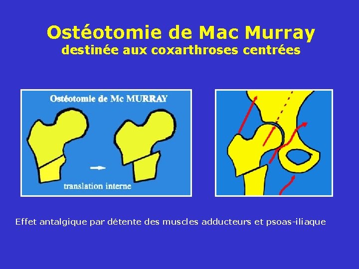 Ostéotomie de Mac Murray destinée aux coxarthroses centrées Effet antalgique par détente des muscles