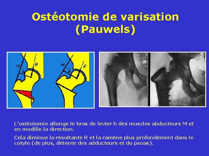 Ostéotomie de varisation (Pauwels) L’ostéotomie allonge le bras de levier h des muscles abducteurs