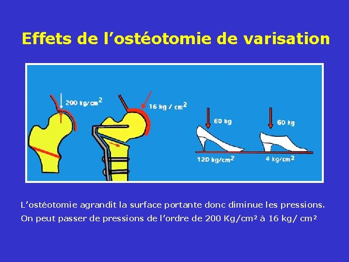 Effets de l’ostéotomie de varisation L’ostéotomie agrandit la surface portante donc diminue les pressions.