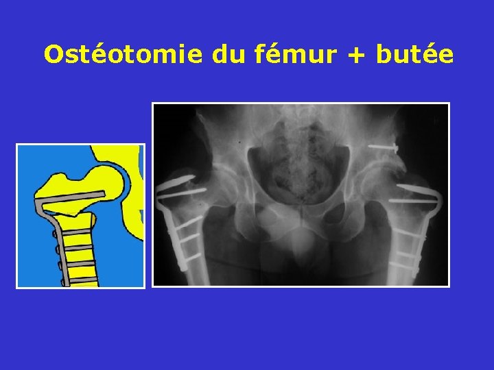 Ostéotomie du fémur + butée 
