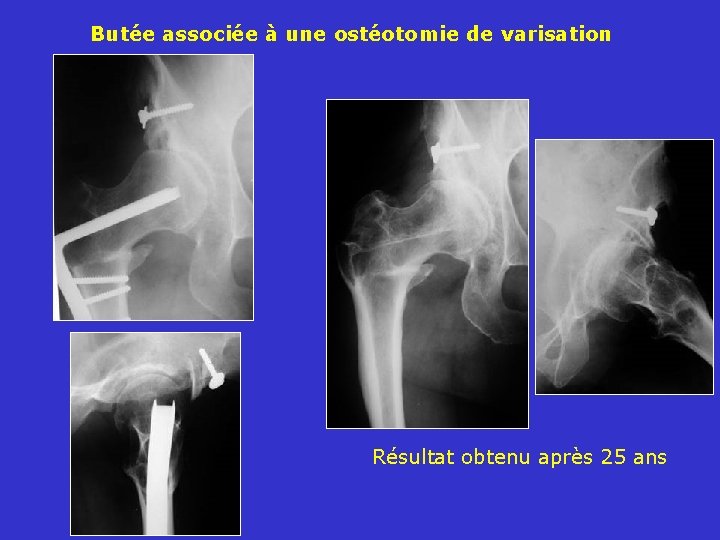 Butée associée à une ostéotomie de varisation Résultat obtenu après 25 ans 