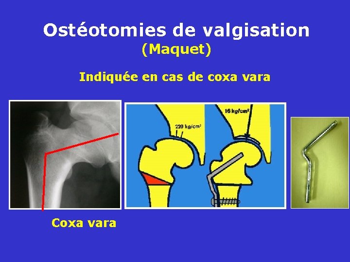 Ostéotomies de valgisation (Maquet) Indiquée en cas de coxa vara Coxa vara 