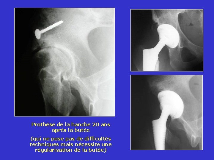 Prothèse de la hanche 20 ans après la butée (qui ne pose pas de