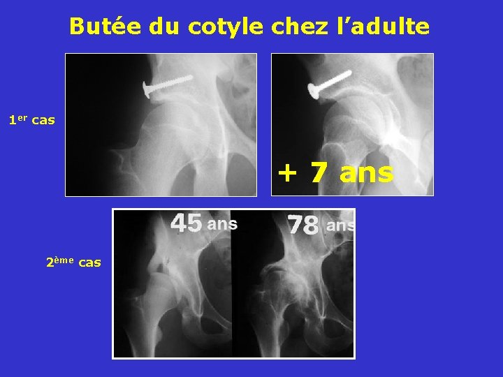 Butée du cotyle chez l’adulte 1 er cas + 7 ans 2ème cas 