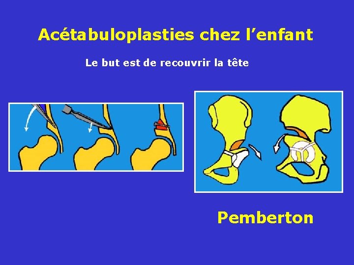 Acétabuloplasties chez l’enfant Le but est de recouvrir la tête Pemberton 