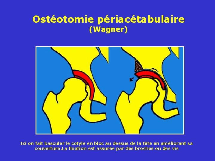 Ostéotomie périacétabulaire (Wagner) Ici on fait basculer le cotyle en bloc au dessus de