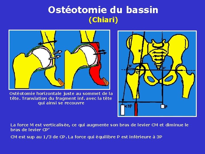 Ostéotomie du bassin (Chiari) Ostéotomie horizontale juste au sommet de la tête. Translation du