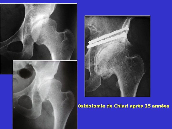  0 stéotomie de Chiari après 25 années 