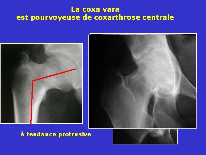 La coxa vara est pourvoyeuse de coxarthrose centrale à tendance protrusive 