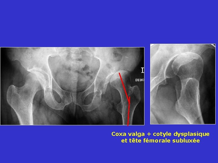 Coxa valga + cotyle dysplasique et tête fémorale subluxée 