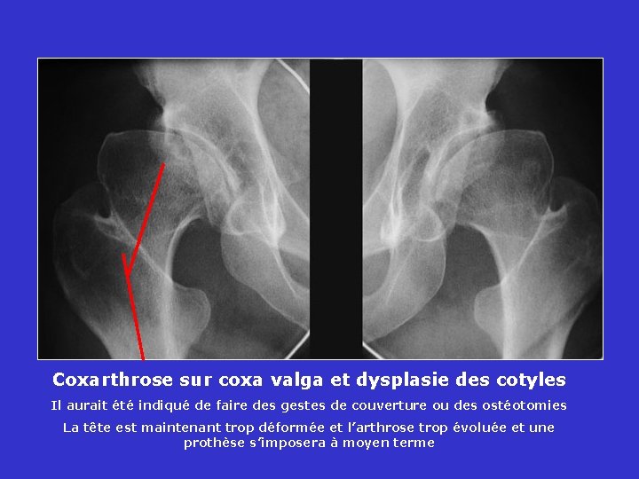 Coxarthrose sur coxa valga et dysplasie des cotyles Il aurait été indiqué de faire