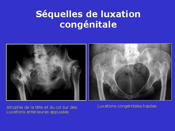 Séquelles de luxation congénitale Atrophie de la tête et du col sur des Luxations