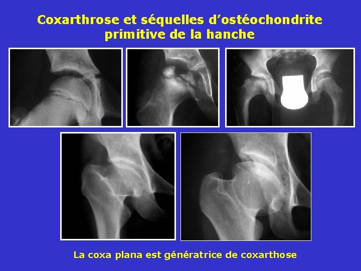 Coxarthrose et séquelles d’ostéochondrite primitive de la hanche La coxa plana est génératrice de