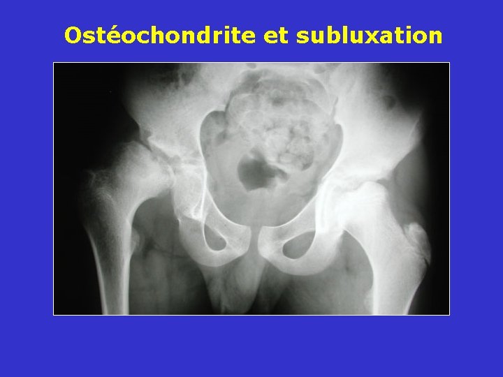 Ostéochondrite et subluxation 