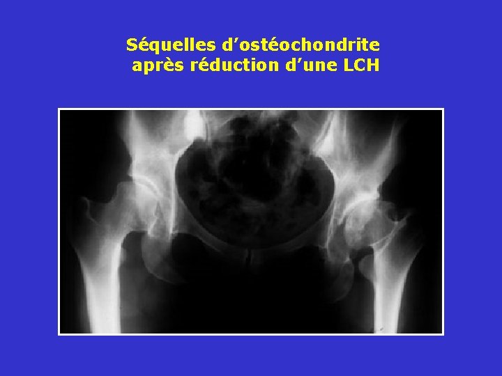 Séquelles d’ostéochondrite après réduction d’une LCH 