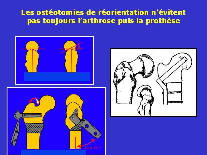 Les ostéotomies de réorientation n’évitent pas toujours l’arthrose puis la prothèse 