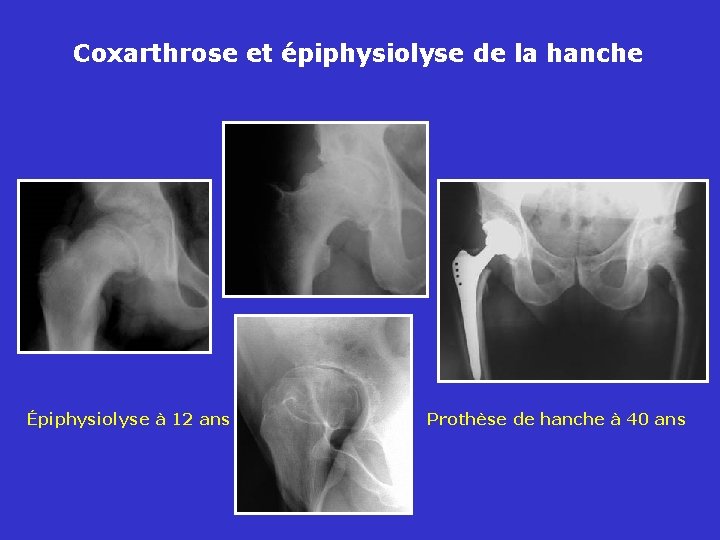 Coxarthrose et épiphysiolyse de la hanche Épiphysiolyse à 12 ans Prothèse de hanche à
