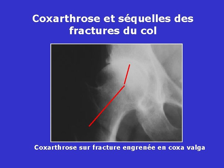 Coxarthrose et séquelles des fractures du col Coxarthrose sur fracture engrenée en coxa valga