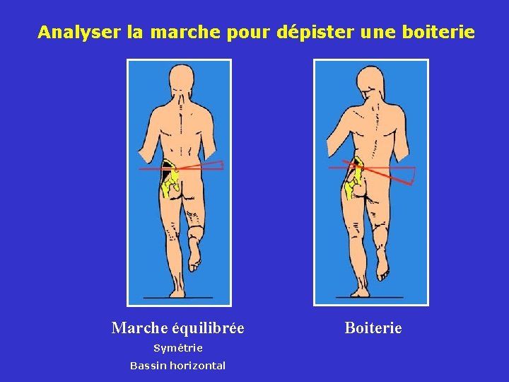 Analyser la marche pour dépister une boiterie Marche équilibrée Symétrie Bassin horizontal Boiterie 