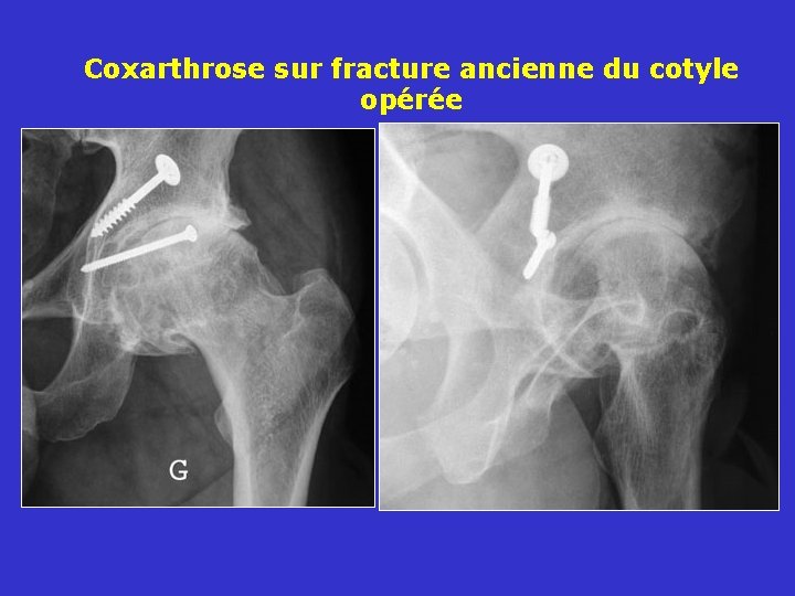 Coxarthrose sur fracture ancienne du cotyle opérée 