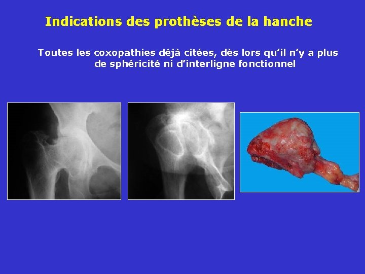 Indications des prothèses de la hanche Toutes les coxopathies déjà citées, dès lors qu’il