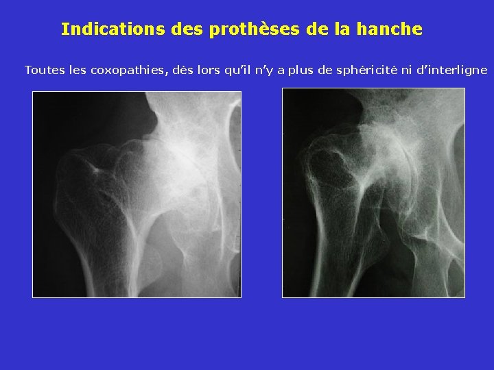 Indications des prothèses de la hanche Toutes les coxopathies, dès lors qu’il n’y a