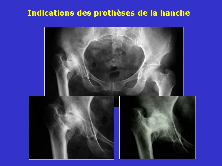 Indications des prothèses de la hanche 