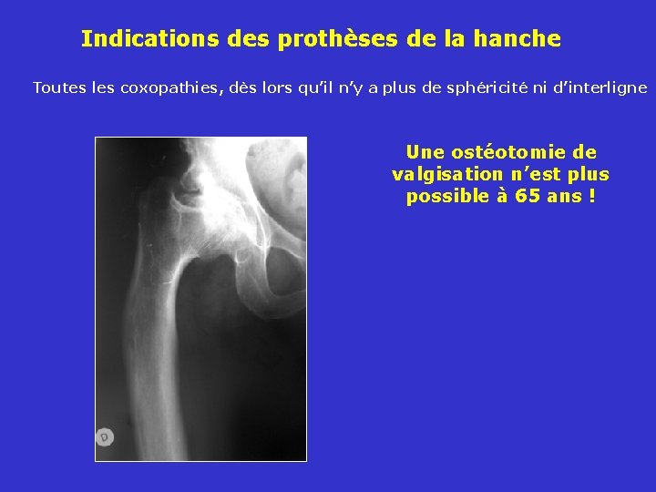 Indications des prothèses de la hanche Toutes les coxopathies, dès lors qu’il n’y a