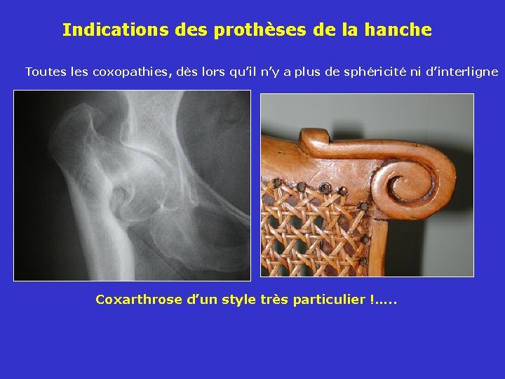 Indications des prothèses de la hanche Toutes les coxopathies, dès lors qu’il n’y a