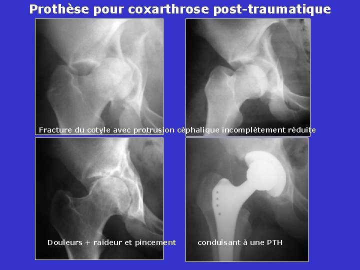 Prothèse pour coxarthrose post-traumatique Fracture du cotyle avec protrusion céphalique incomplètement réduite Douleurs +